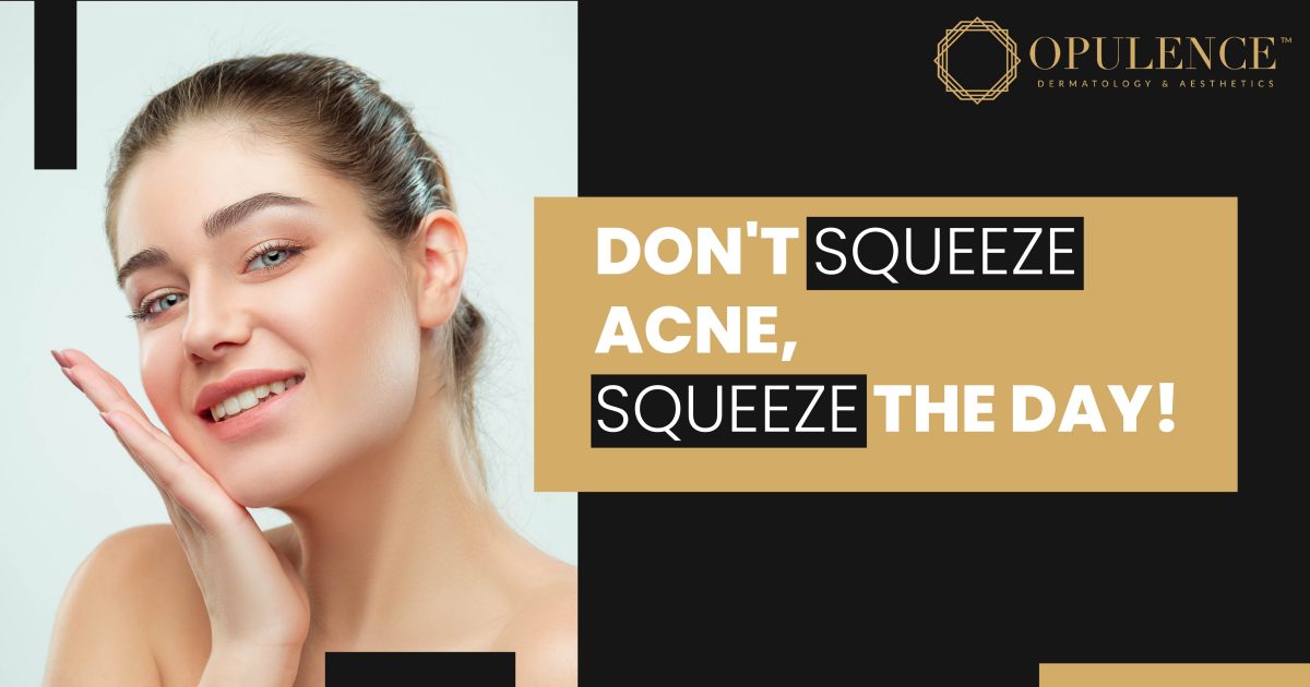 Don't Squeeze Acne, Squeeze the Day!