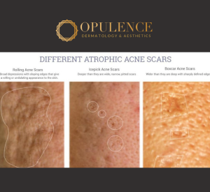 Different type of Acne scar