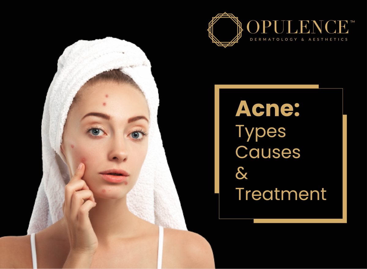 ACNE: TYPES, CAUSES, AND TREATMENTS